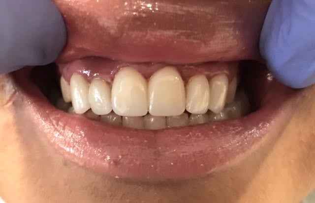 After Photo: Dental Veneers