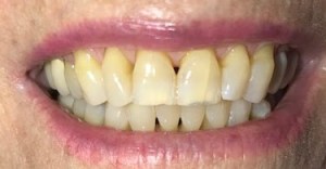 BioClear Before service