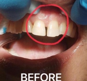 Before Dental Bonding