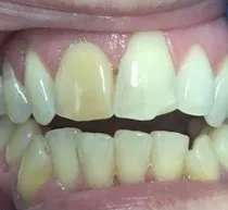 bioclear before and after