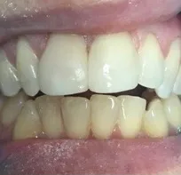 bioclear before and after
